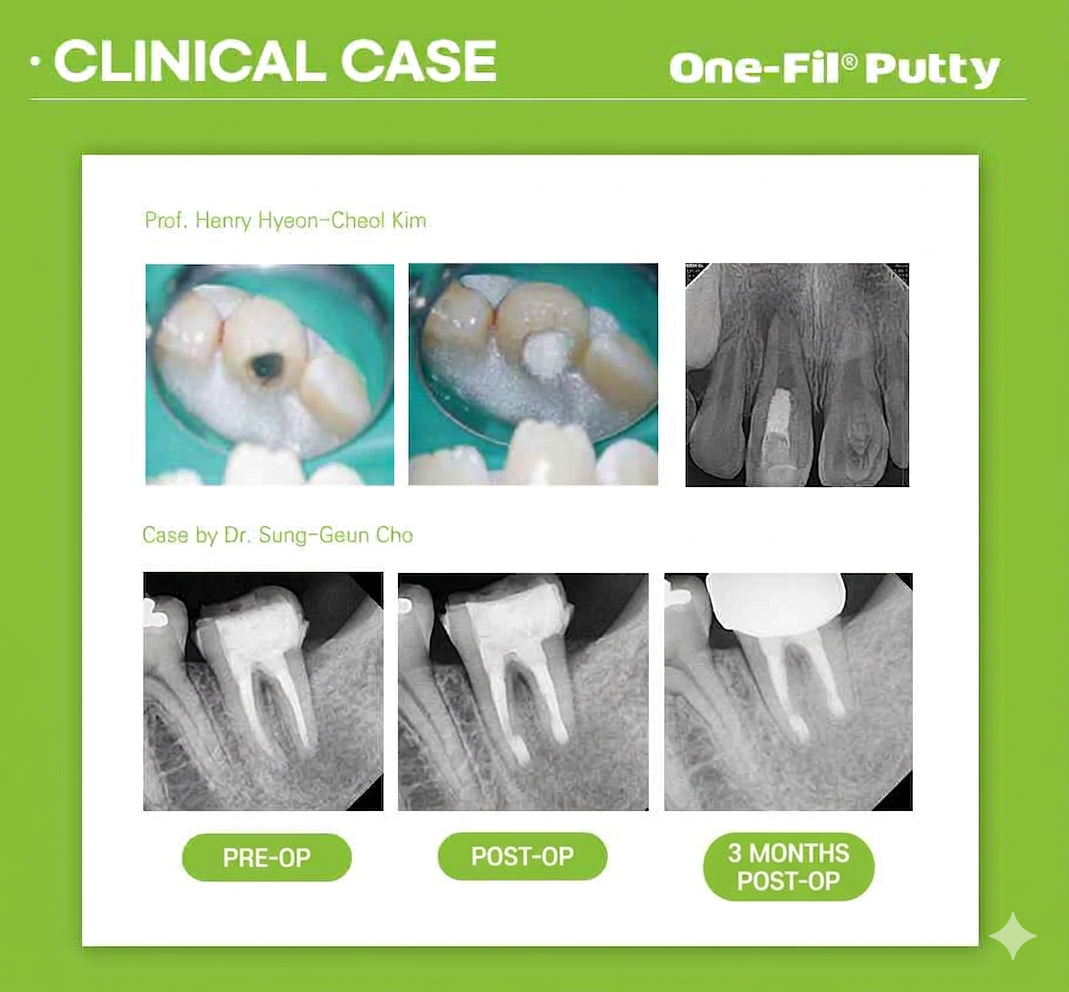 One-Fil PT(Putty)